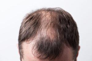 Balding man's head